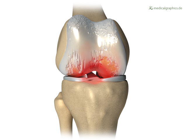 Ignited knee osteoarthritis