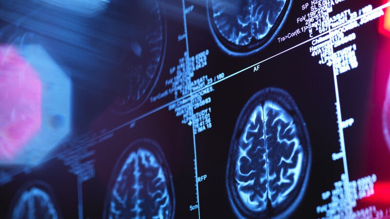 Brain scan - dementia
